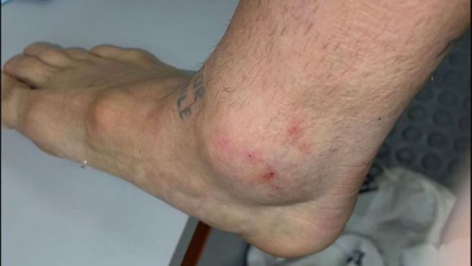 La impactante foto del tobillo del "Papu" Gómez tras el duelo con Chile