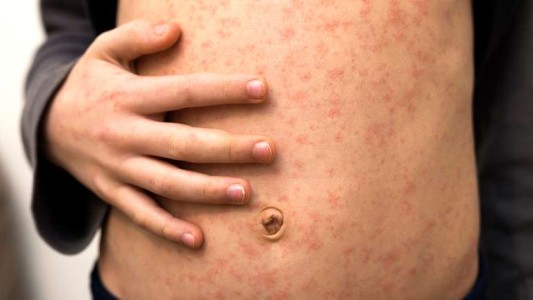 Sarampión: cómo se contagia, quiénes deben vacunarse y quiénes no