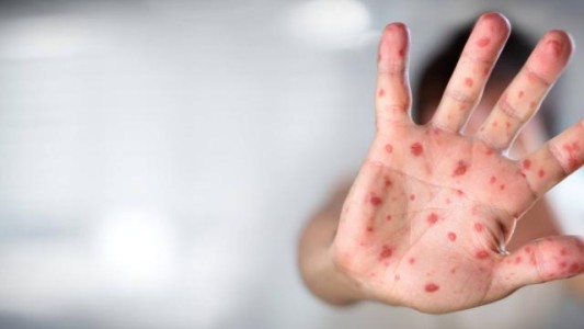 Viruela del mono: el Reino Unido registró 57 casos