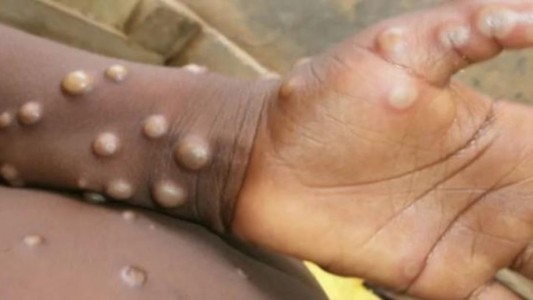 Viruela del mono: "No sólo hay varones sino también mujeres y pediátricos", aseguró especialista