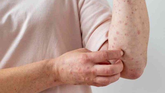 Trece casos confirmados de viruela del mono en el país