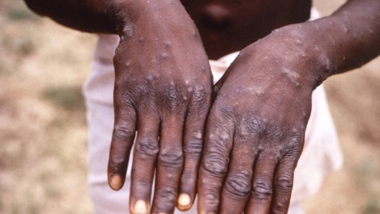 Viruela del mono: un experto de la OMS estimó que no se tardará mucho en declarar la pandemia