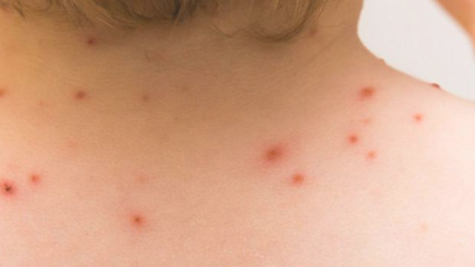 Se confirmó el primer caso de viruela del mono en la provincia