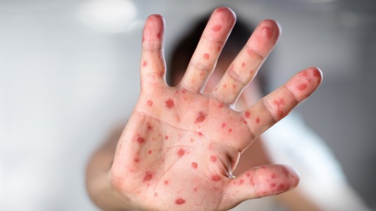 Confirmaron el segundo caso de viruela del mono en la provincia de Santa Fe