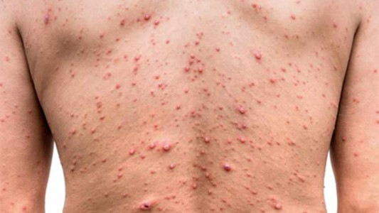 Viruela del mono: Confirman un total de 480 casos en la Argentina