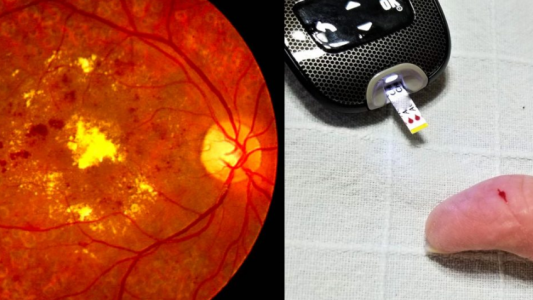 Santa Fe adhiere a la Campaña Nacional de Prevención de Retinopatía Diabética