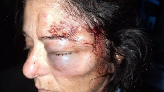 Rosario: desfiguraron a colectivera con brutal golpiza durante un robo