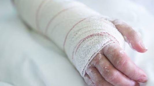 Por un reto viral de de TikTok, un adolescente terminó con el 30% de su cuerpo quemado