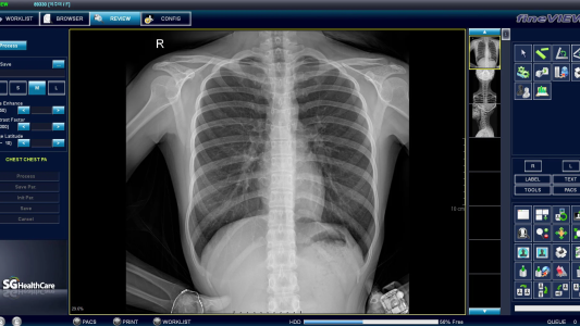 El gobierno licitó la compra de 40 digitalizadores de placas radiográficas
