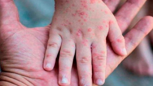 Avanza la viruela del mono en Argentina: reportaron 10 casos nuevos