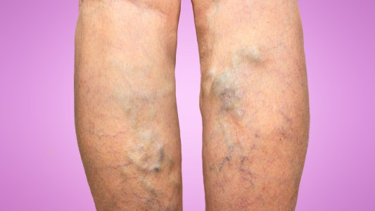 Día Mundial de la Trombosis: cómo prevenirla