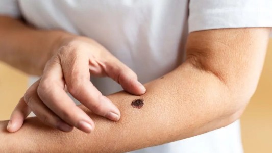 Santa Fe registra 50 muertes al año por cáncer de piel: cómo prevenirlo