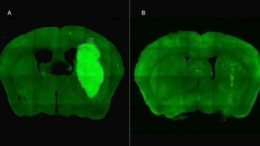 Novedosa estrategia terapéutica: especialistas del CONICET lograron frenar un tipo de cáncer cerebral
