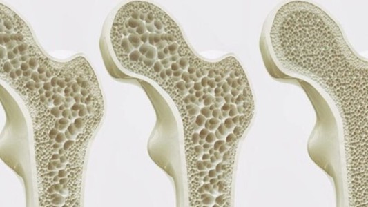 Día Mundial de la Osteoporosis: una de cada tres mujeres mayores de 50 años sufrirá una fractura por osteoporosis