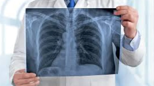 Día Mundial del Cáncer de Pulmón: alertan sobre el aumento de casos