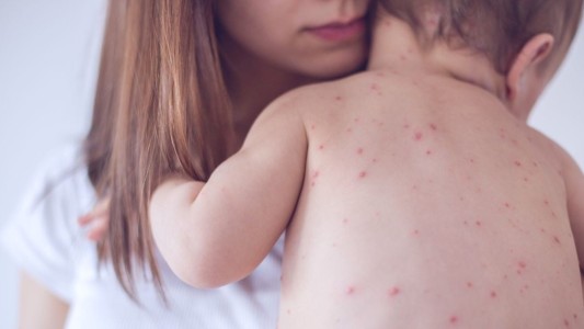 Sarampión: El Ministerio de Salud emitió alerta epidemiológica