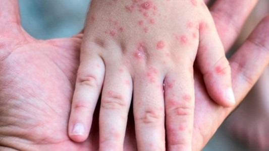 Emitieron alerta tras la circulación de viajeros con sarampión: incluye a Santa Fe