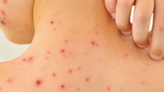 Brote de sarampión en México: registraron 9.074 casos, el mayor índice de América