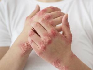 Alarma por el aumento de sífilis en jóvenes: crecen los casos en la Región Centro