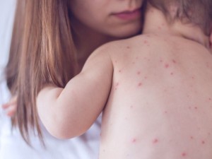 Sarampión: El Ministerio de Salud emitió alerta epidemiológica