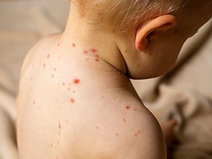 Sarampión: se confirma caso en Entre Ríos y la provincia refuerza los controles